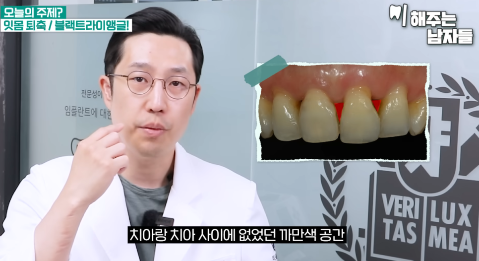 서울역사랑니 치아 블랙트라이앵글, 어떻게 해야 될까요? 관련 이미지 1