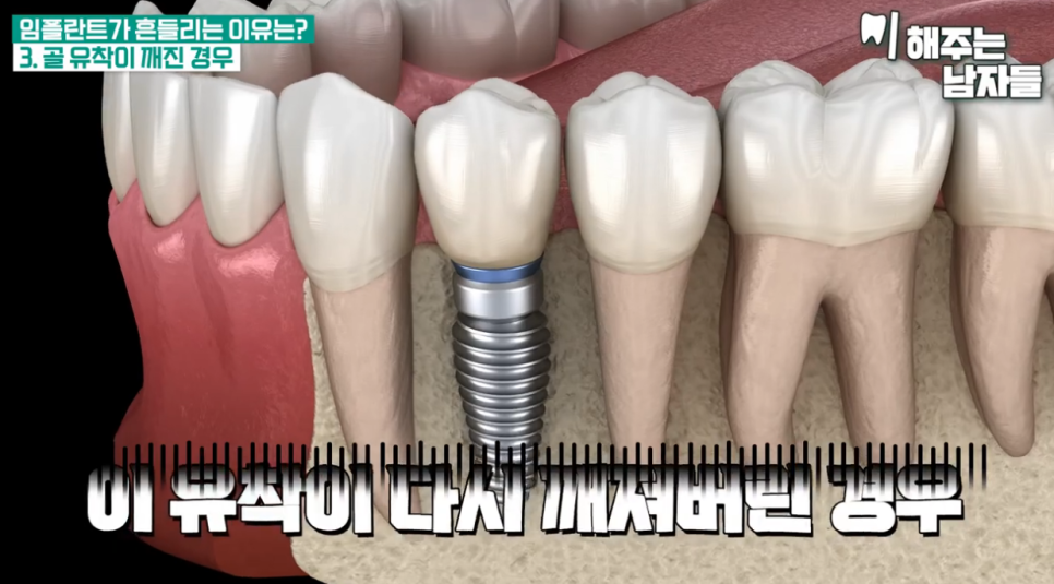 임플란트빠짐 & 흔들림, 당장 치과 가야 하는 이유와 대처법까지 관련 이미지 7
