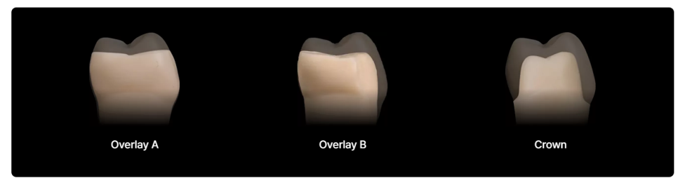 치아보존치료 선택 전이라면, 오버레이치과 기준을 먼저 아셔야 합니다. 관련 이미지 7