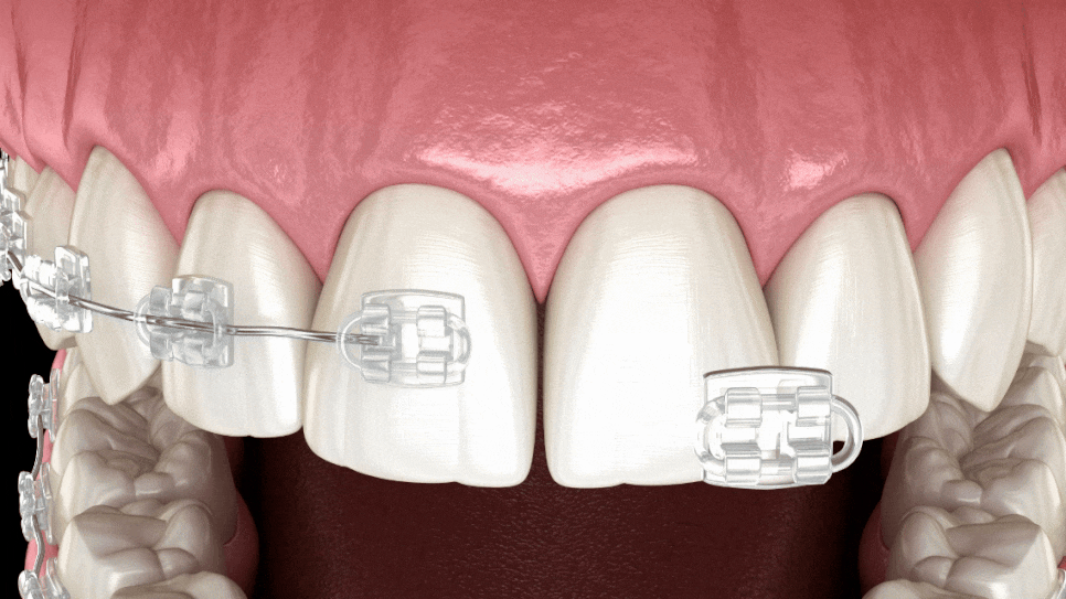 벌어진앞니, 레진 vs 교정? 이 기준 모르면 다시 벌어집니다. 관련 이미지 4