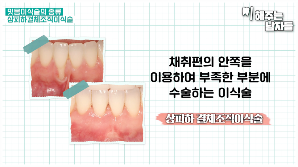 잇몸이식수술로 내려앉은 잇몸 다시 건강하게 채우는 법 관련 이미지 8