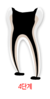 충치레진 vs 인레이&middot;크라운 차이, 언제 결정될까요? 관련 이미지 8