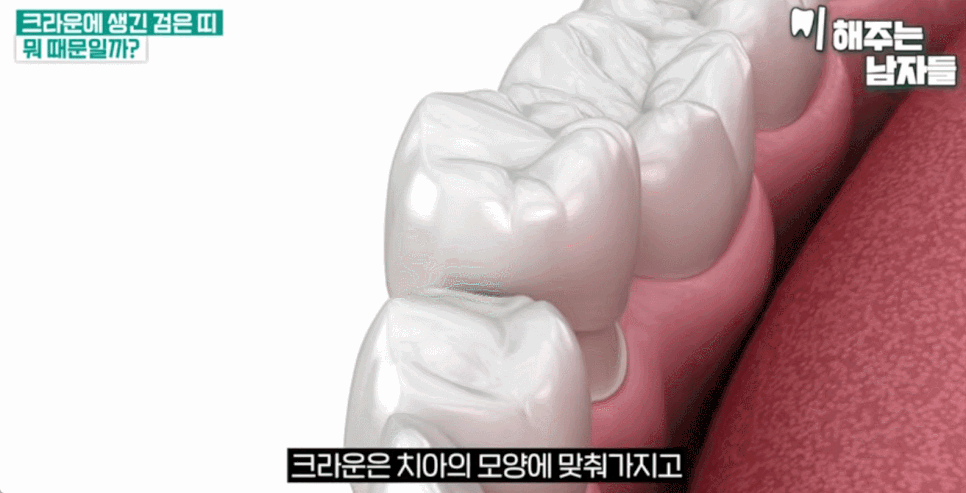 앞니 크라운 교체 시점, 앞니 크라운 수명이 아니라 &lsquo;이 기준&rsquo;입니다. 관련 이미지 4