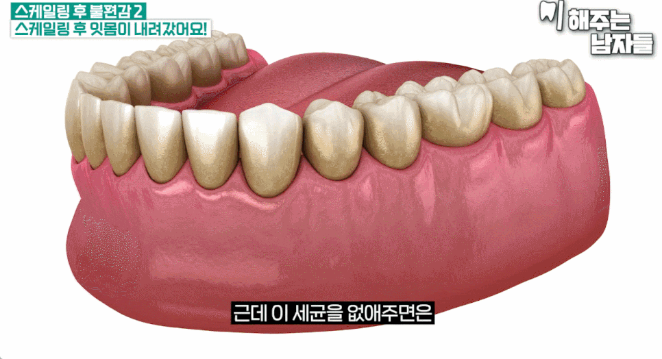 잇몸 스케일링 오해와 진실 & 아프지 않게 치료받는 법까지 관련 이미지 7
