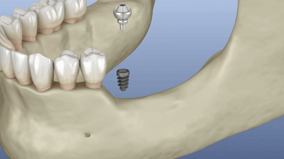 신경치료? 임플란트? 치아 상태를 보면 답이 보입니다. 관련 이미지 5