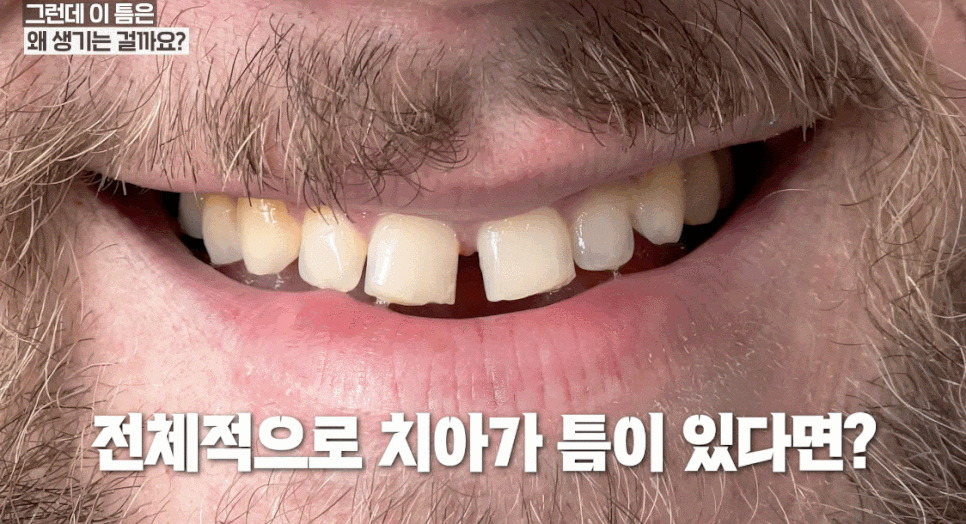 벌어진앞니, 레진 vs 교정? 이 기준 모르면 다시 벌어집니다. 관련 이미지 2