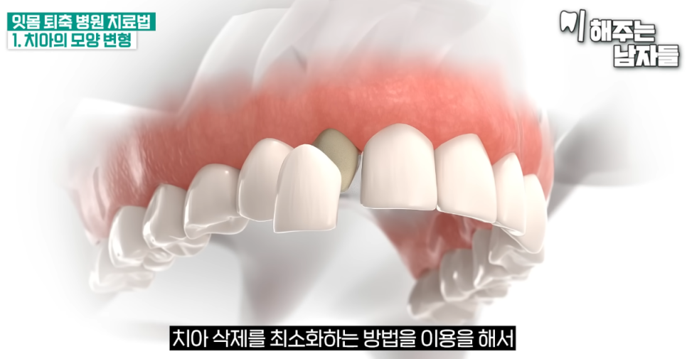 서울역사랑니 치아 블랙트라이앵글, 어떻게 해야 될까요? 관련 이미지 6