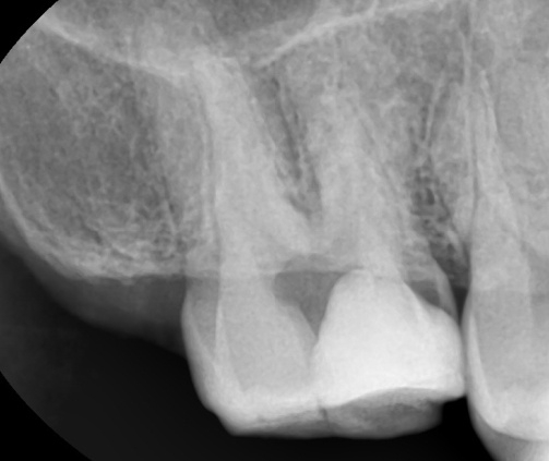 [리더스진치과] 충치진단기를 이용한 충치진단 그리고 충치치료, 언제 신경치료를 해야하는지, 방사선 사진과 임상사진으로 확인 후 진단과정 공개 관련 이미지 5