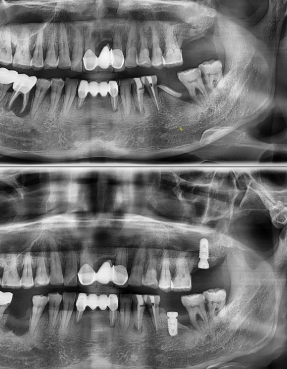 [숭실대입구역] [임플란트] 리더스진치과 2022.5.30 발치후 즉시 임플란트 상악동수술 뼈이식 관련 이미지 1