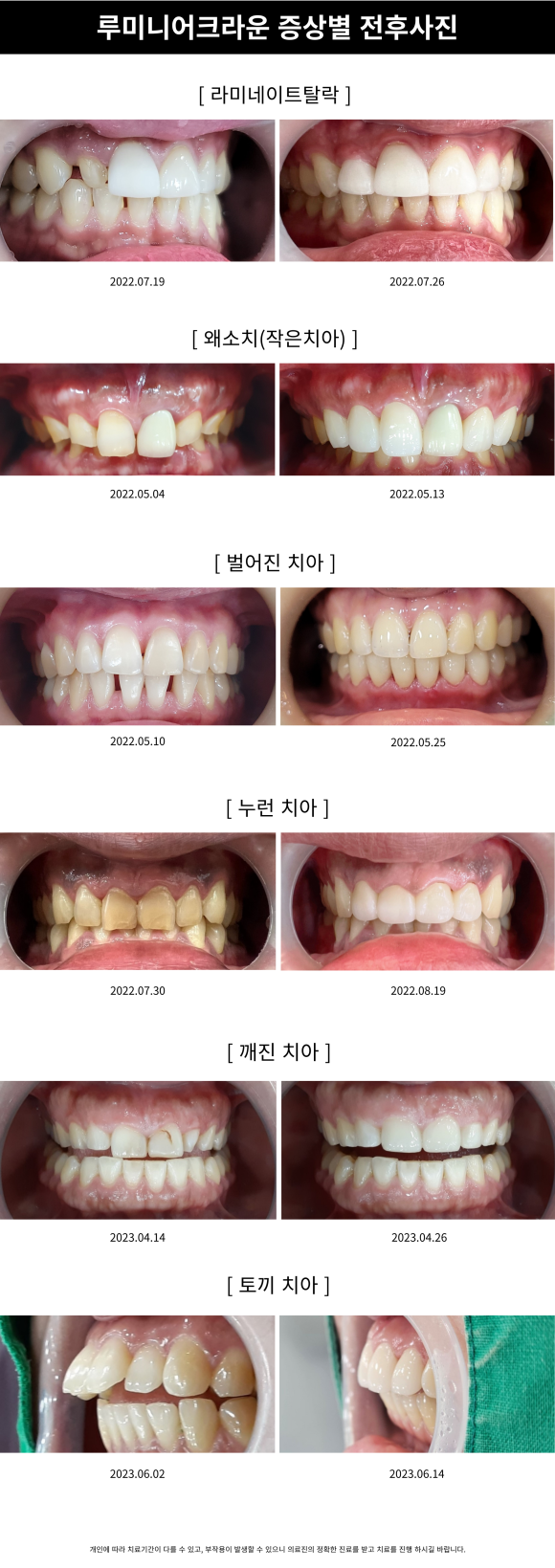 나이 상관없이 환하게 웃고싶다면? 붙이지 않고 씌우는 치아성형 관련 이미지 4