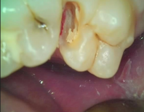 [리더스진치과] 충치진단기를 이용한 충치진단 그리고 충치치료, 언제 신경치료를 해야하는지, 방사선 사진과 임상사진으로 확인 후 진단과정 공개 관련 이미지 3