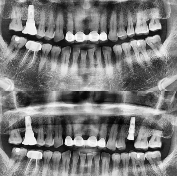 [숭실대입구역] [임플란트] 리더스진치과 2022.7.2 발치 후 즉시식립 임플란트 관련 이미지 1