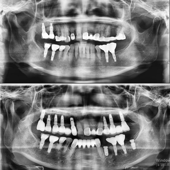 [숭실대입구역] 리더스진치과 임플란트 케이스 관련 이미지 1