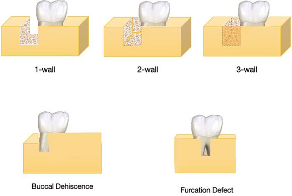 [숭실대입구역] 리더스진치과 - 발치후 즉시 식립 임플란트 & 왜 사람마다 임플란트 기간이 다르고 뼈이식 여부가 다를까? 관련 이미지 2