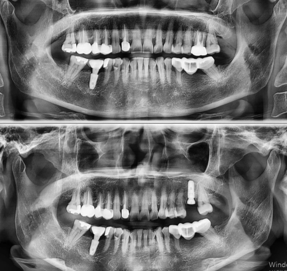 [숭실대입구역] [임플란트] 리더스진치과 2022.3.2 구치부 발치 후 즉시 임플란트 관련 이미지 1