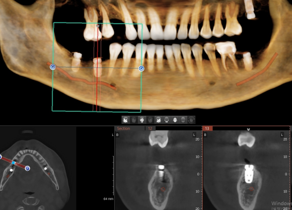 [숭실대입구역] [임플란트] 리더스진치과 2022.6.30 인천에서 오신 분의 당일 내과 협진 후 임플란트 식립 관련 이미지 4