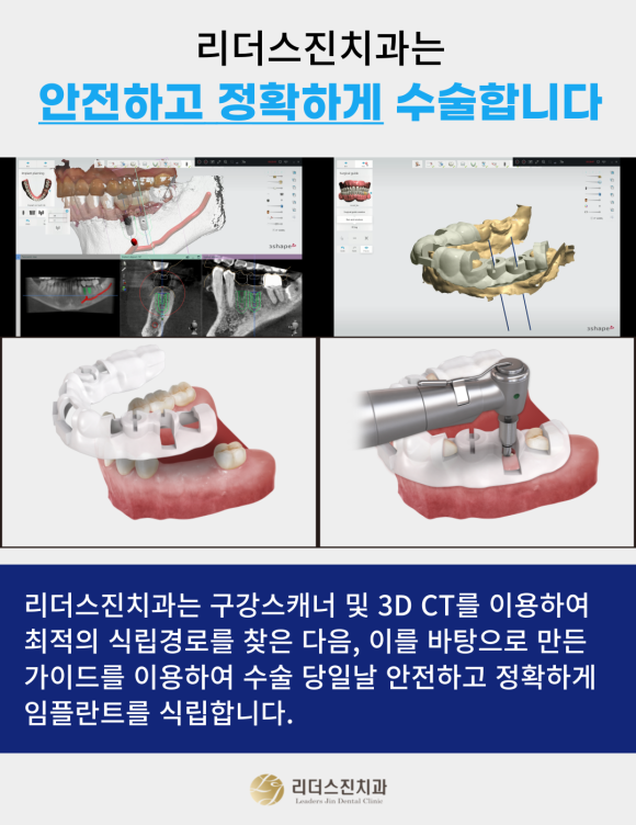상도동 치과 임플란트비용 가격도 중요하지만 더 중요한건? 관련 이미지 3