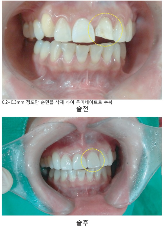 [숭실대입구역] [심미보철] 앞니 파절치아 루미네이트 심미보철 완성. 관련 이미지 1