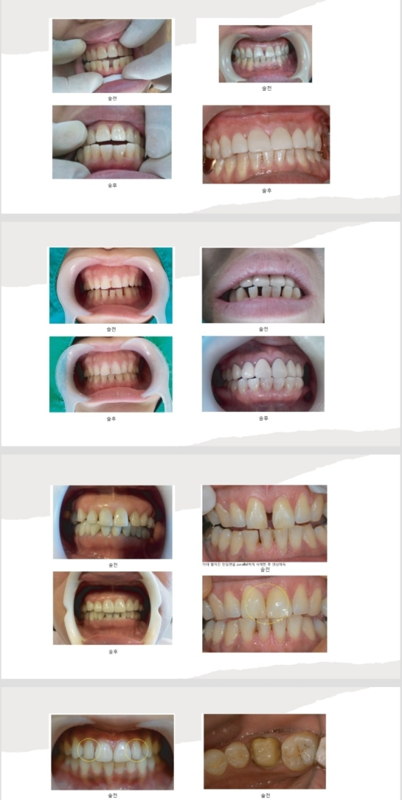 <<<<리더스진치과의 심미보철(루미니어크라운) 프로토콜>> 관련 이미지 6