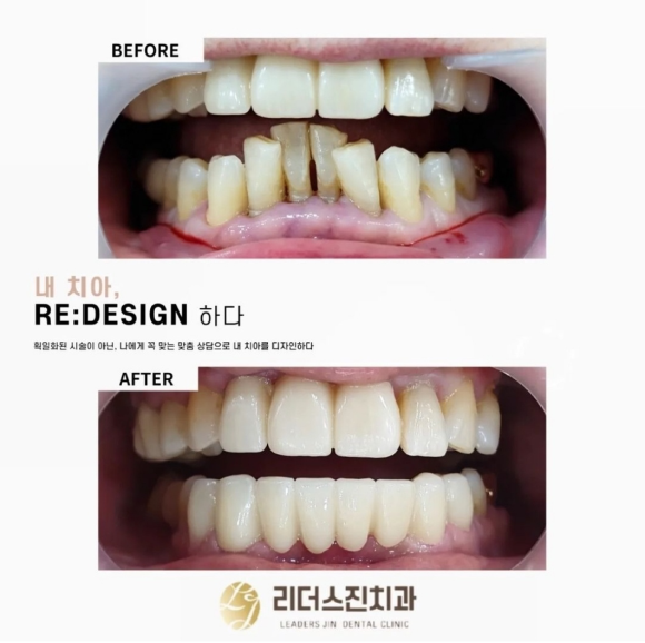[숭실대입구역] [심미보철] 리더스진치과 심미보철 연예인보철 인플루언서치과 관련 이미지 1