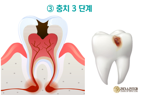 상도동 치과, 충치진행 단계별 치료방법은?? 관련 이미지 5