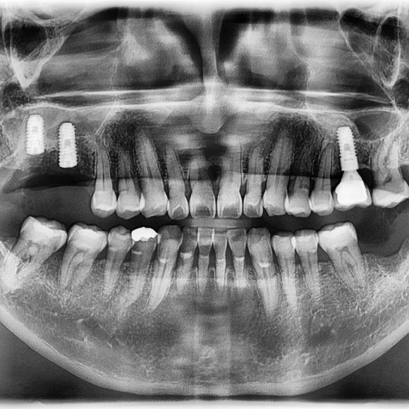 [숭실대입구역] 리더스진치과 임플란트 케이스 관련 이미지 2