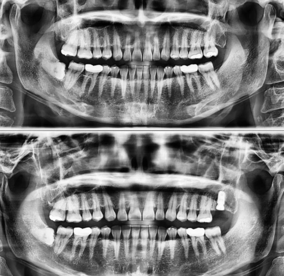 [숭실대입구역] [임플란트] 리더스진치과 2022.6.14 발치 후 당일 즉시 식립 임플란트 수술. 관련 이미지 1