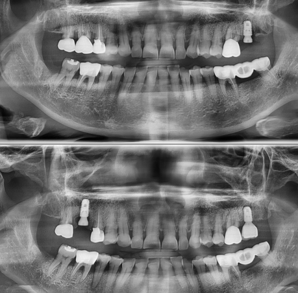 [숭실대입구역] [임플란트] 리더스진치과 2022.5.18 발치후 즉시 임플란트 상악동수술 뼈이식 관련 이미지 1