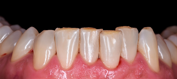 리더스진치과 턱 보톡스, 이갈이 와 사각턱 동시에 해결! 관련 이미지 1