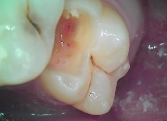 [리더스진치과] 충치진단기를 이용한 충치진단 그리고 충치치료, 언제 신경치료를 해야하는지, 방사선 사진과 임상사진으로 확인 후 진단과정 공개 관련 이미지 4