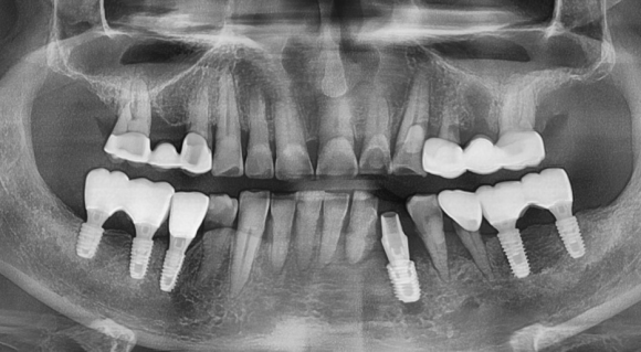 [리더스진 치과] 잇몸질환 으로 무너져버린 뼈 그리고 당일식립 임플란트 치료 전략 관련 이미지 2