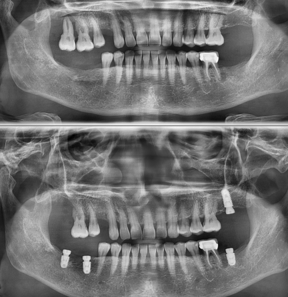 [숭실대입구역] [임플란트] 리더스진치과 2022.6.30 인천에서 오신 분의 당일 내과 협진 후 임플란트 식립 관련 이미지 1