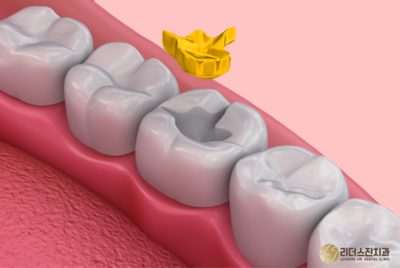 상도동 치과, 충치진행 단계별 치료방법은?? 관련 이미지 4