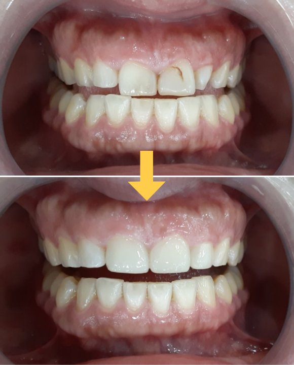 앞니깨짐, 루미니어크라운으로 깨진앞니 바로 치료하는 이유 관련 이미지 3