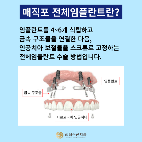 [상도동 치과] 전체임플란트 어디서 할지 고민이신가요?? 관련 이미지 3