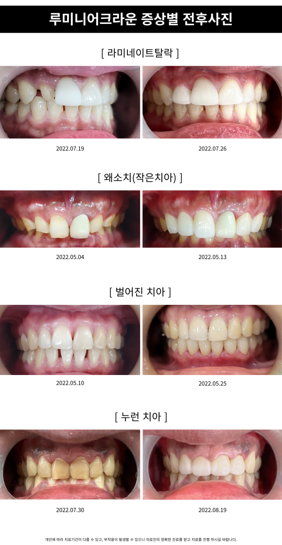 앞니 치아성형, "루미니어크라운"으로 가리지말고 당당하게 웃으세요~!!, [상도동치과 리더스진치과] 관련 이미지 4