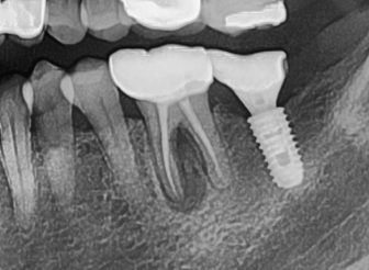 무증상의 치근단 농양, 잠재적인 생명 위협 관련 이미지 2