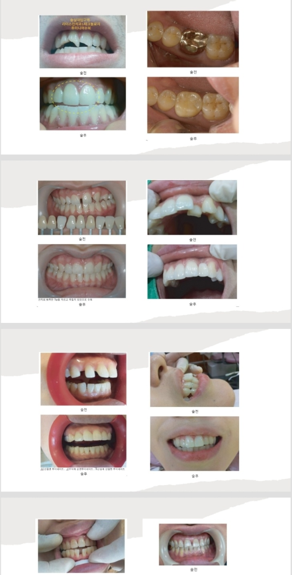 <<<<리더스진치과의 심미보철(루미니어크라운) 프로토콜>> 관련 이미지 5