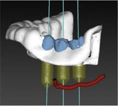 [리더스진 치과] 잇몸질환 으로 무너져버린 뼈 그리고 당일식립 임플란트 치료 전략 관련 이미지 4