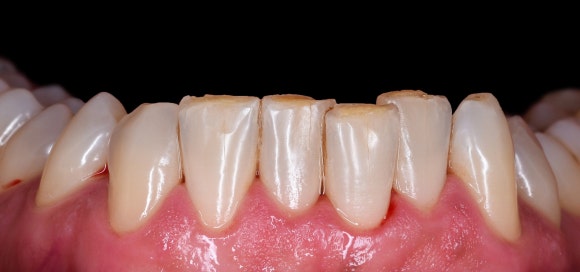 잠잘 때 이갈이 하시나요? 이갈이 마우스피스의 중요성 관련 이미지 1