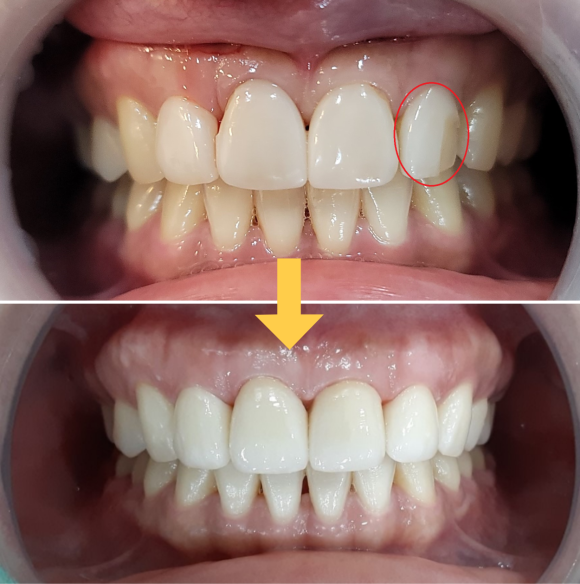 앞니깨짐, 루미니어크라운으로 깨진앞니 바로 치료하는 이유 관련 이미지 2