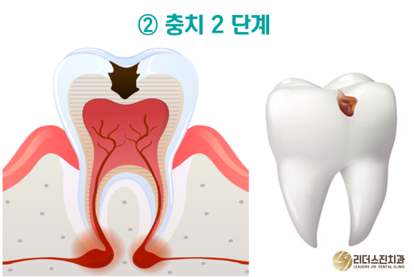 상도동 치과, 충치진행 단계별 치료방법은?? 관련 이미지 3