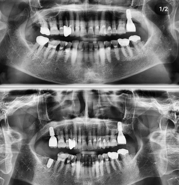 [숭실대입구역] [임플란트] 딱딱한 음식을 좋아하는 60대 남성분의 임플란트 식립 관련 이미지 1