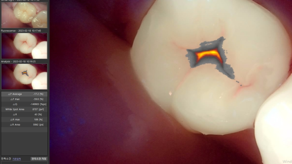 [숭실대입구역] 리더스진치과 - 충치진단기를 이용한 충치 검진과 간단한 충치치료 그리고 충치치료비용/ 치과마다 충치갯수가 다른 것을 해결하는 방법. 관련 이미지 2
