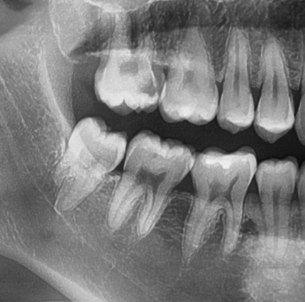 [리더스진치과] 충치진단기를 이용한 충치진단 그리고 충치치료, 언제 신경치료를 해야하는지, 방사선 사진과 임상사진으로 확인 후 진단과정 공개 관련 이미지 1