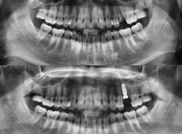 [숭실대입구역] [임플란트] 리더스진치과 2022.5.3 발치후 즉시 임플란트 관련 이미지 1