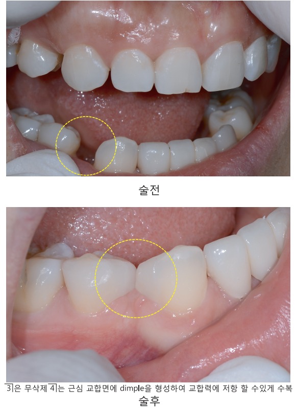[숭실대입구역] [심미보철] 루미네이트 루미니어크라운 앞니 심미보철 완성. 관련 이미지 1