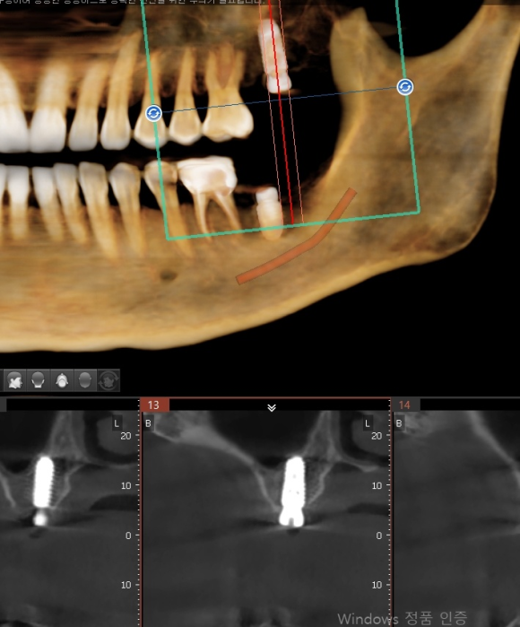 [숭실대입구역] [임플란트] 리더스진치과 2022.6.30 인천에서 오신 분의 당일 내과 협진 후 임플란트 식립 관련 이미지 2