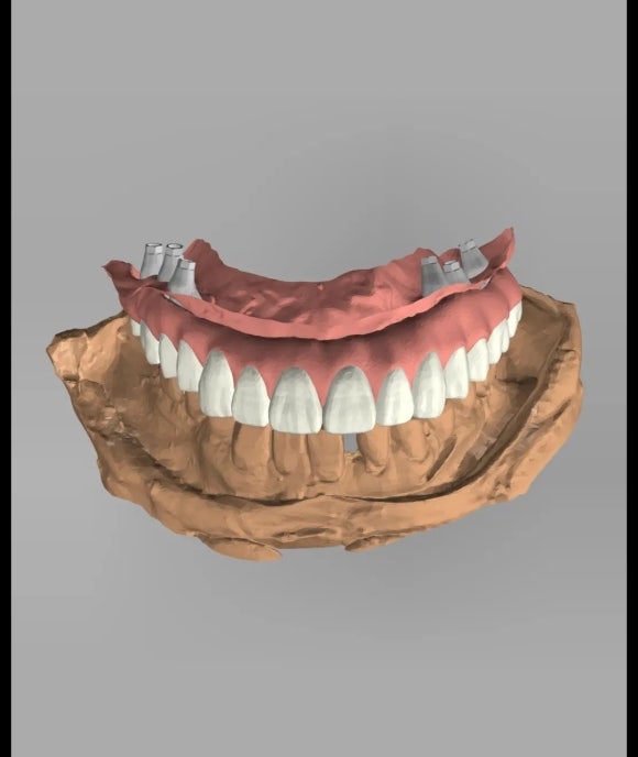 서울 상도동 치과, 99% AI 디지털 보철 원데이 보철 시스템 관련 이미지 2
