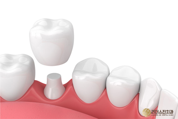 상도동 치과, 충치진행 단계별 치료방법은?? 관련 이미지 6